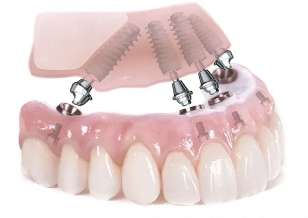 My Dentist Geelong (Highton) provides immediate dental implant solutions for full arch restoration, allowing patients in Geelong to regain their smile quickly.