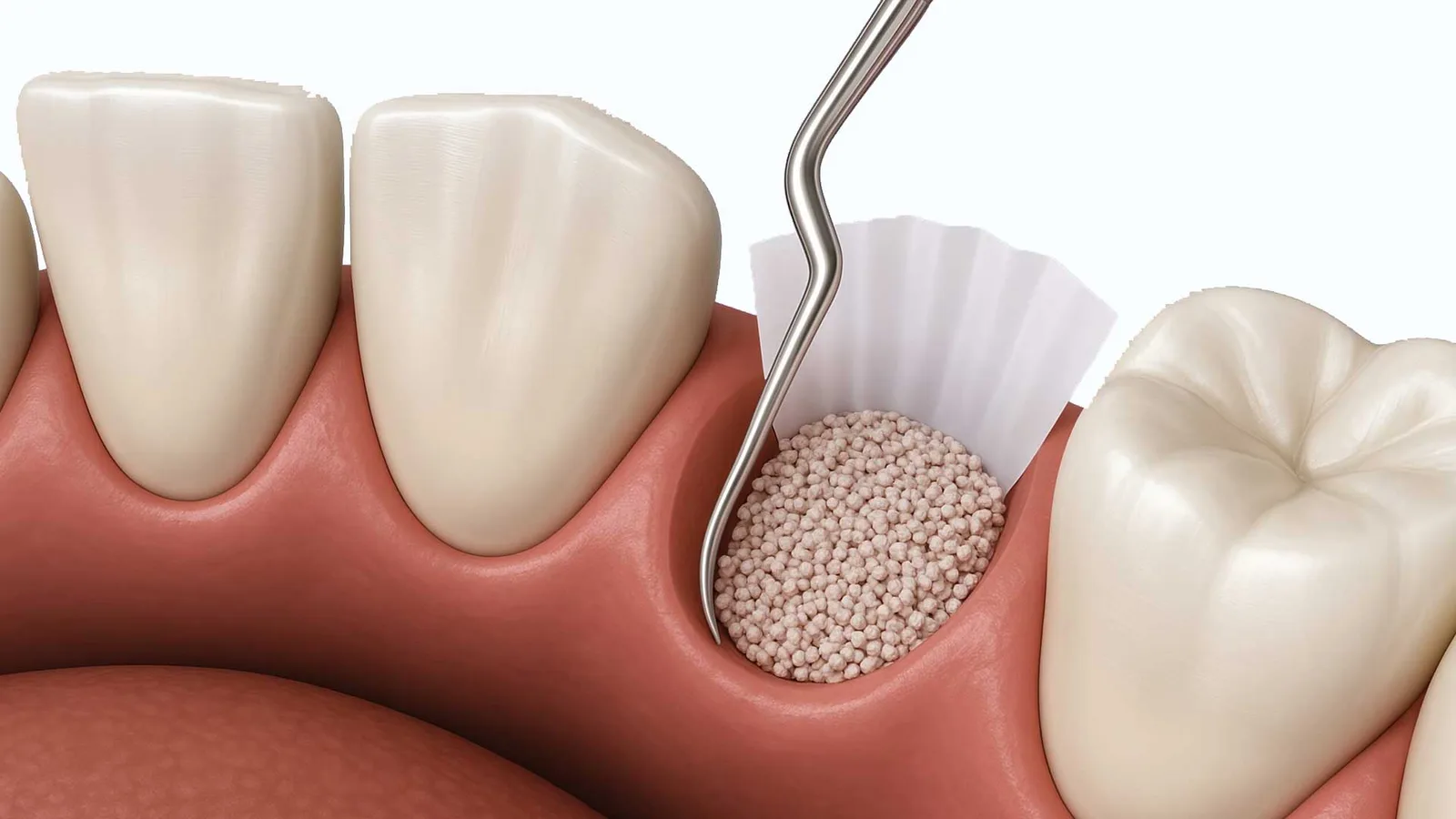 Bone Grafting
