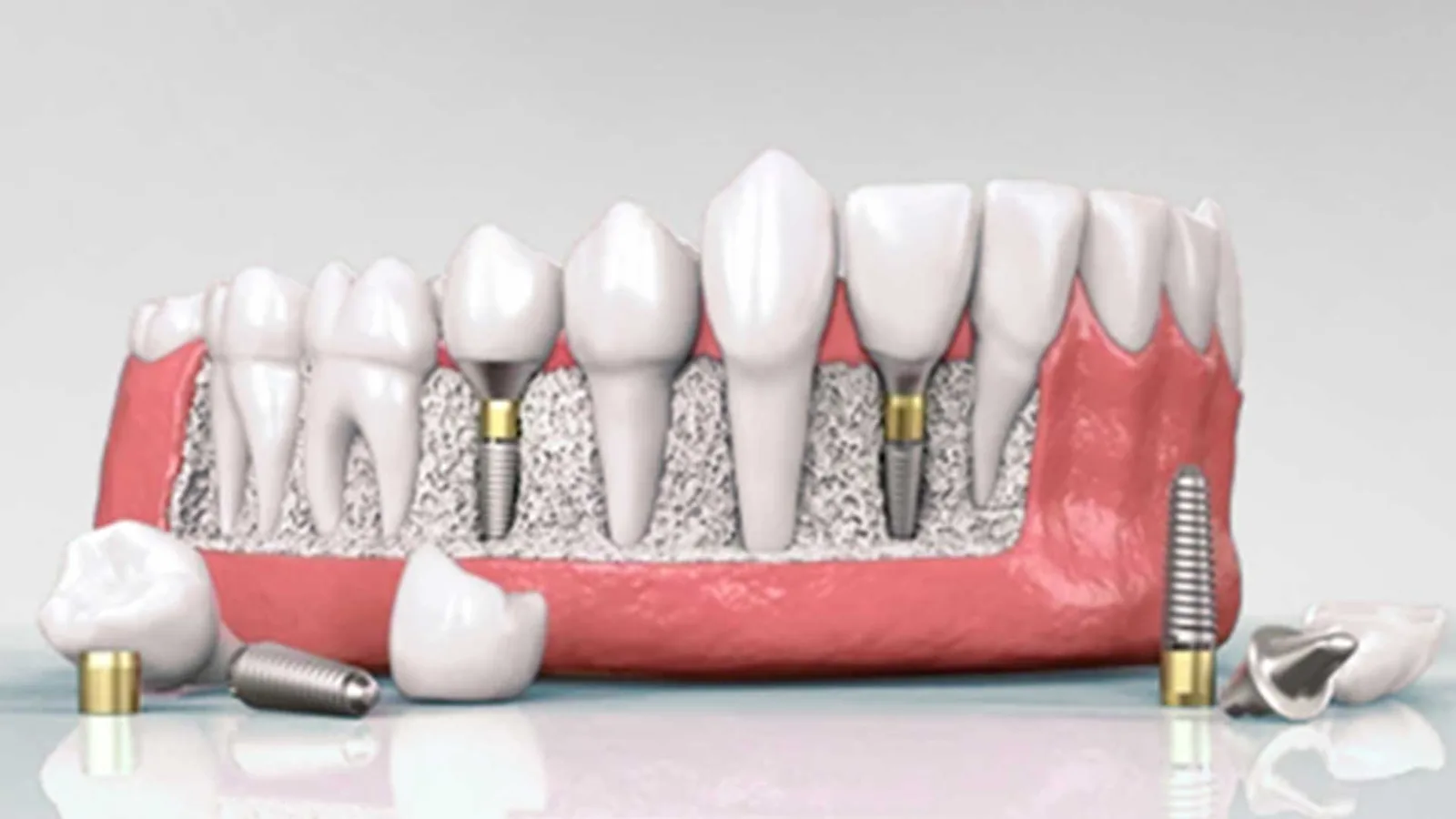 Dental Implants