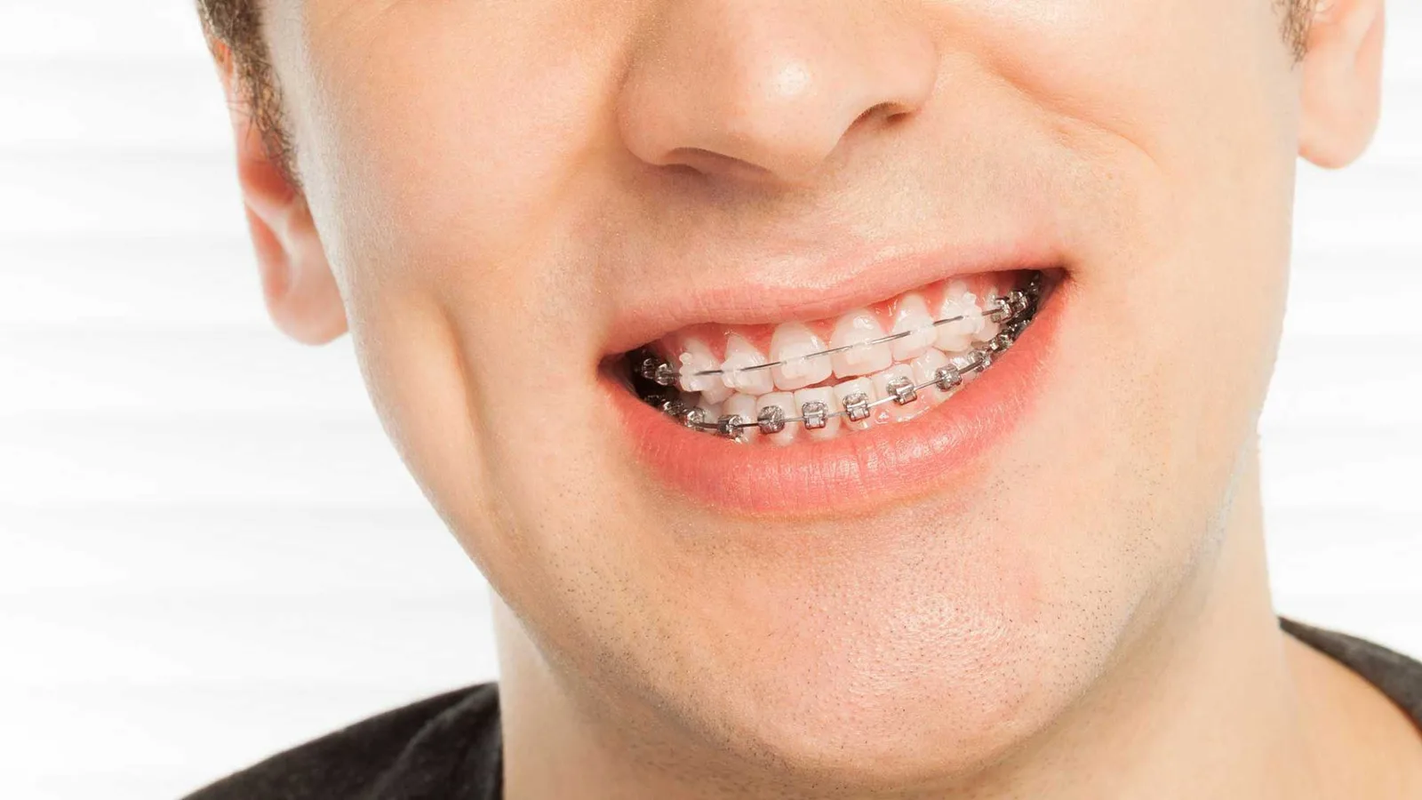 Dental Braces