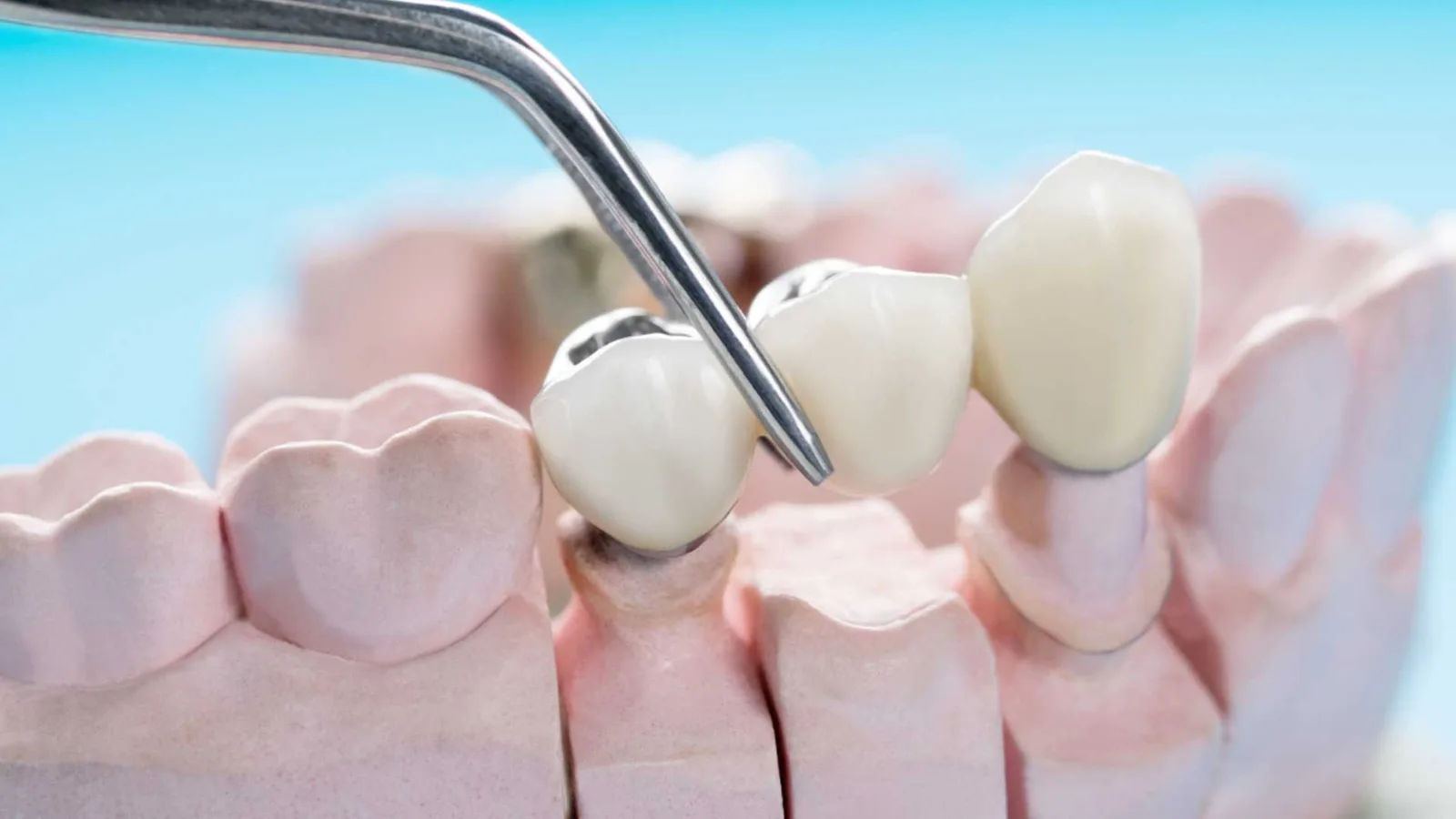 Dental Bridges