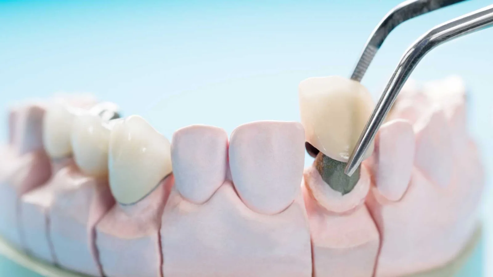 Dental Crowns