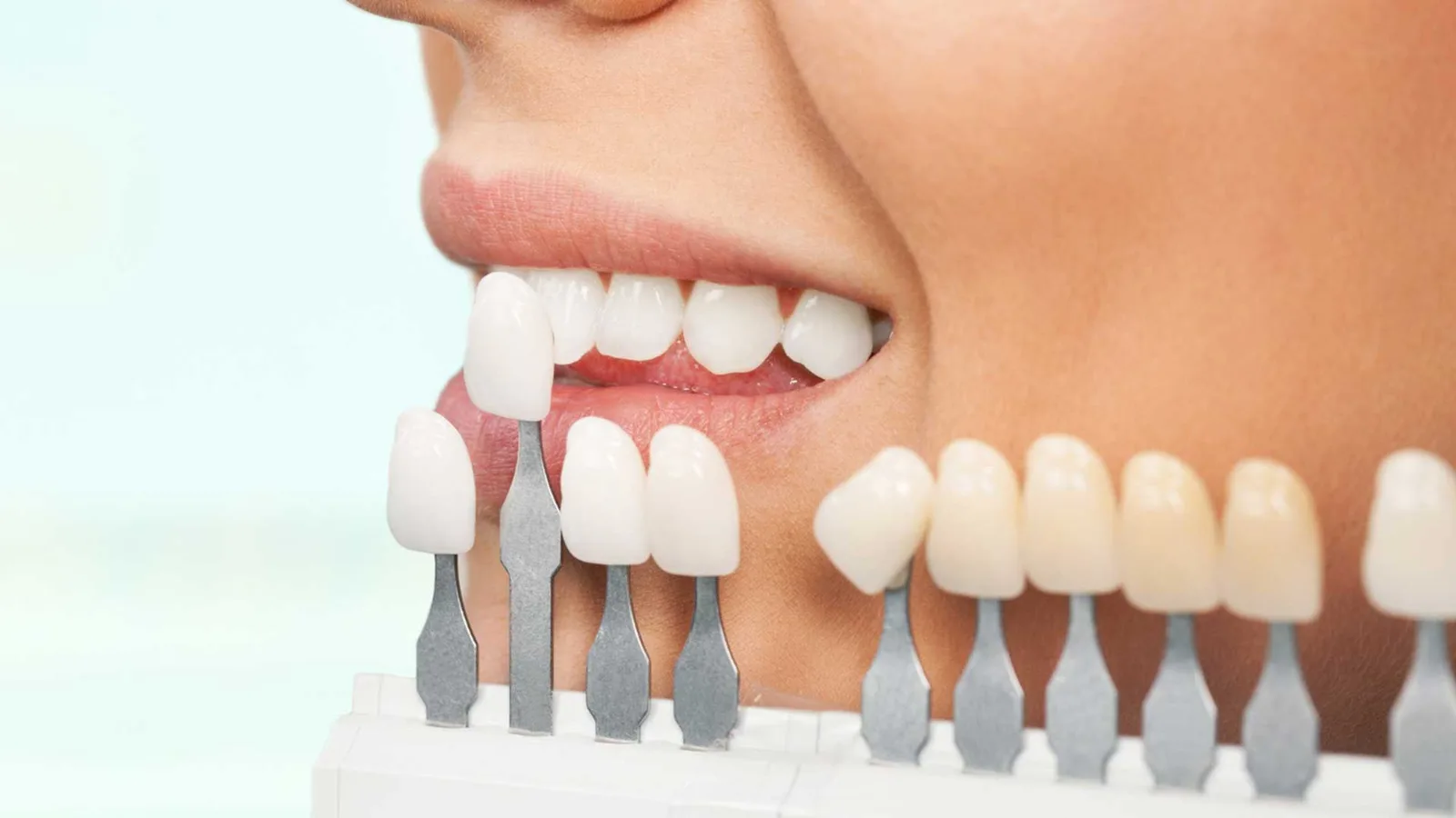 Dental Veneers