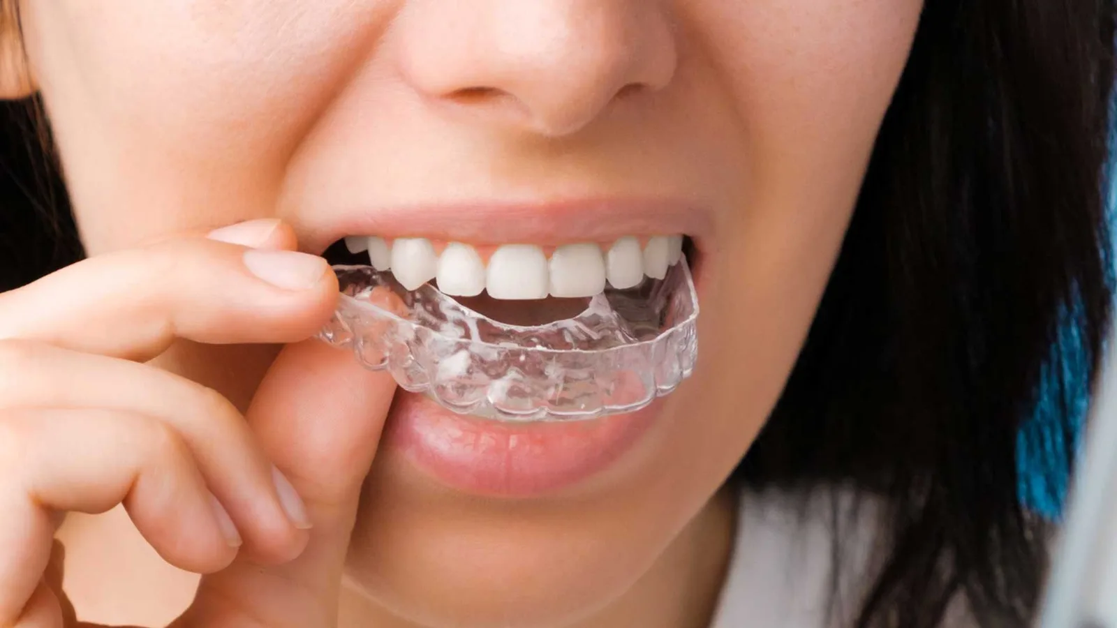 Invisalign®
