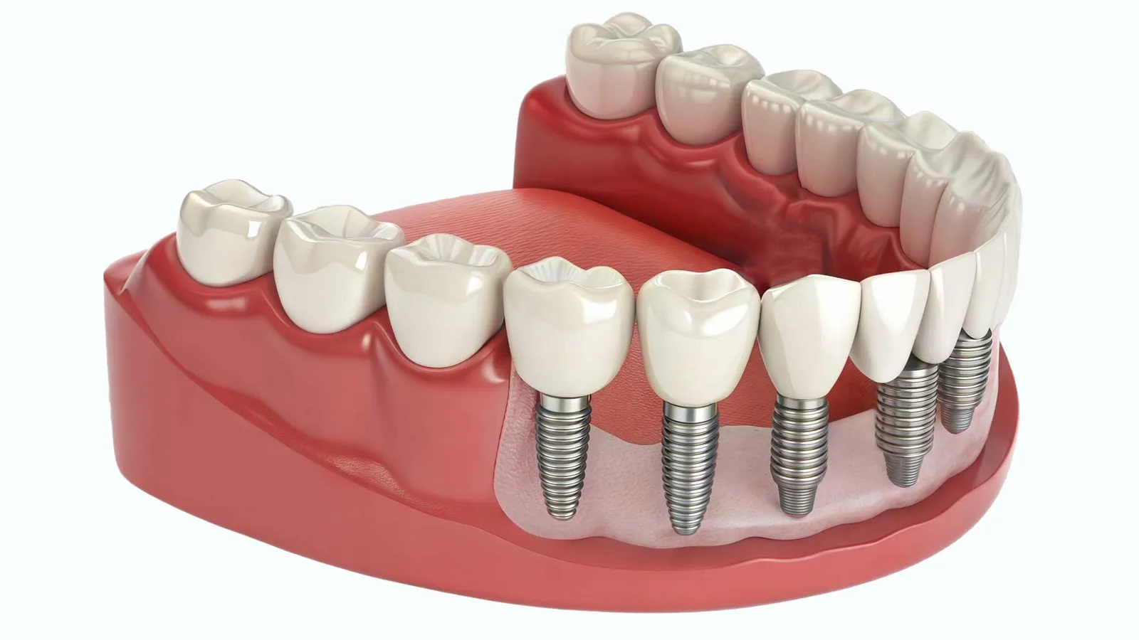 My Dentist Geelong (Highton) provides personalized assessments in Geelong to determine if dental implants are the right solution for replacing your missing teeth.