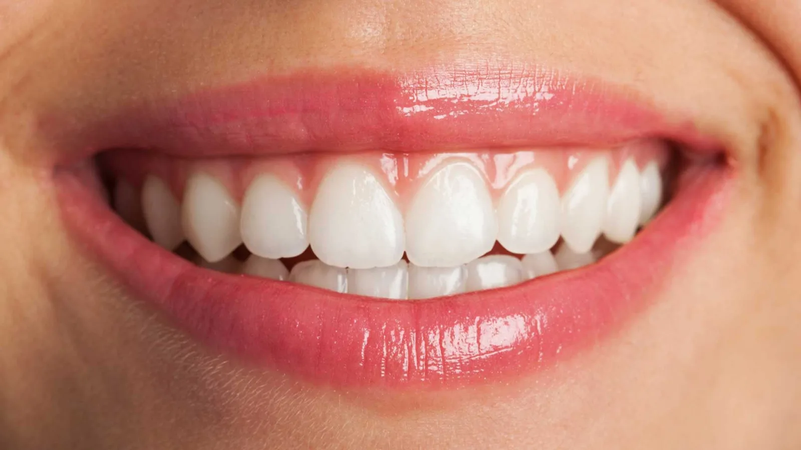 Teeth Whitening