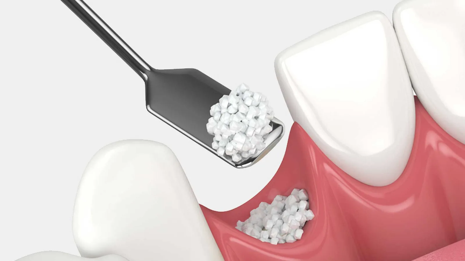 My Dentist Geelong (Highton) provides expert bone grafting services to ensure optimal jawbone height and width for successful restorative dental outcomes.
