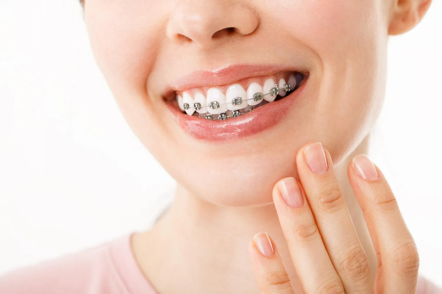 Braces are connected by a thin archwire.