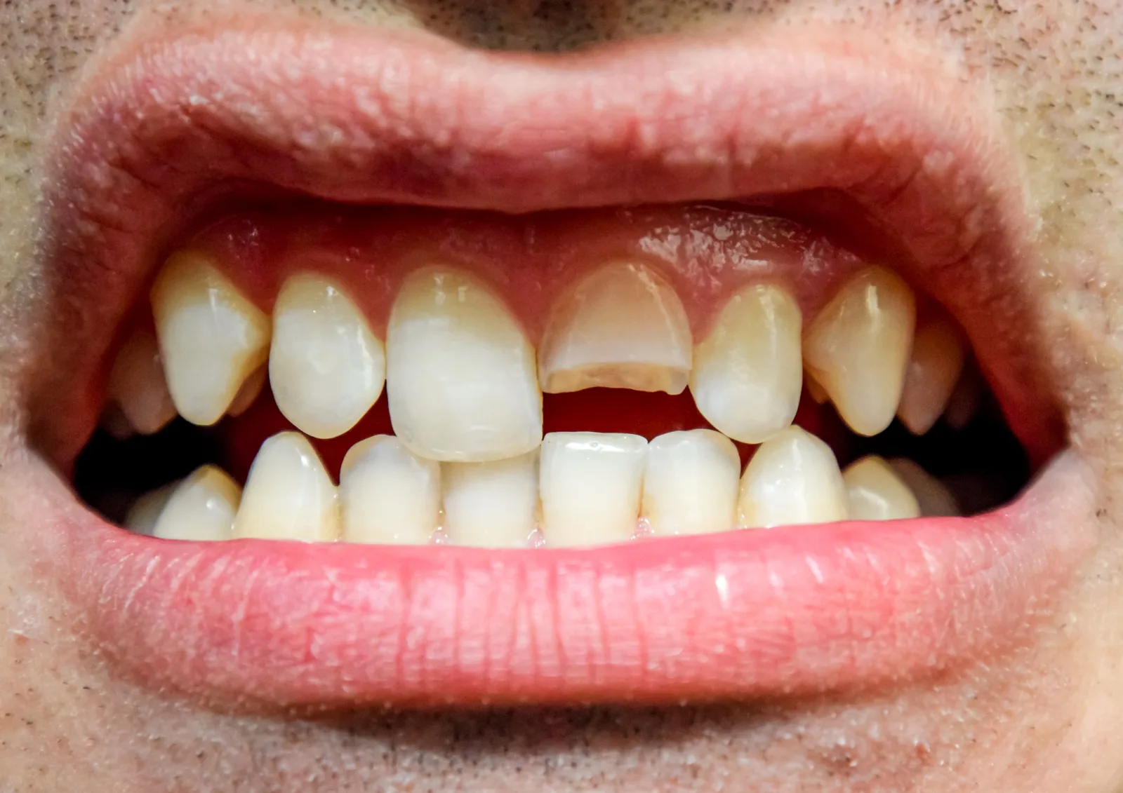 Small cracks or chips in teeth can trigger sensitivity and discomfort when left untreated.