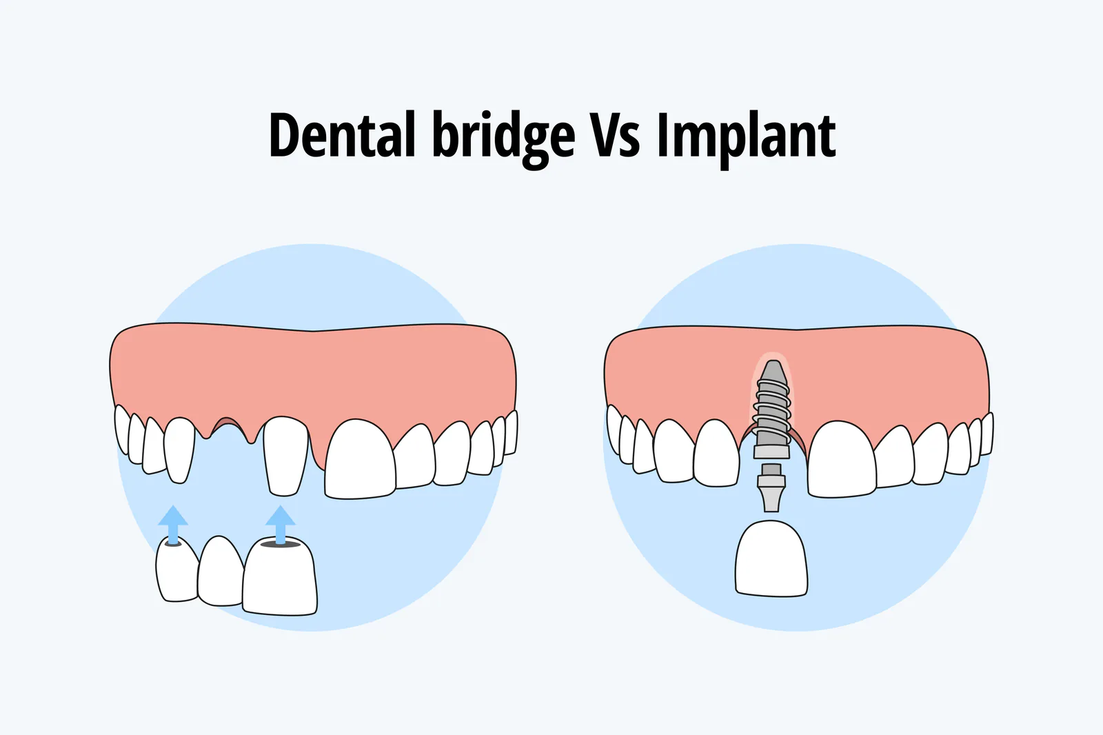 The comparison between dental bridge and dental implant.