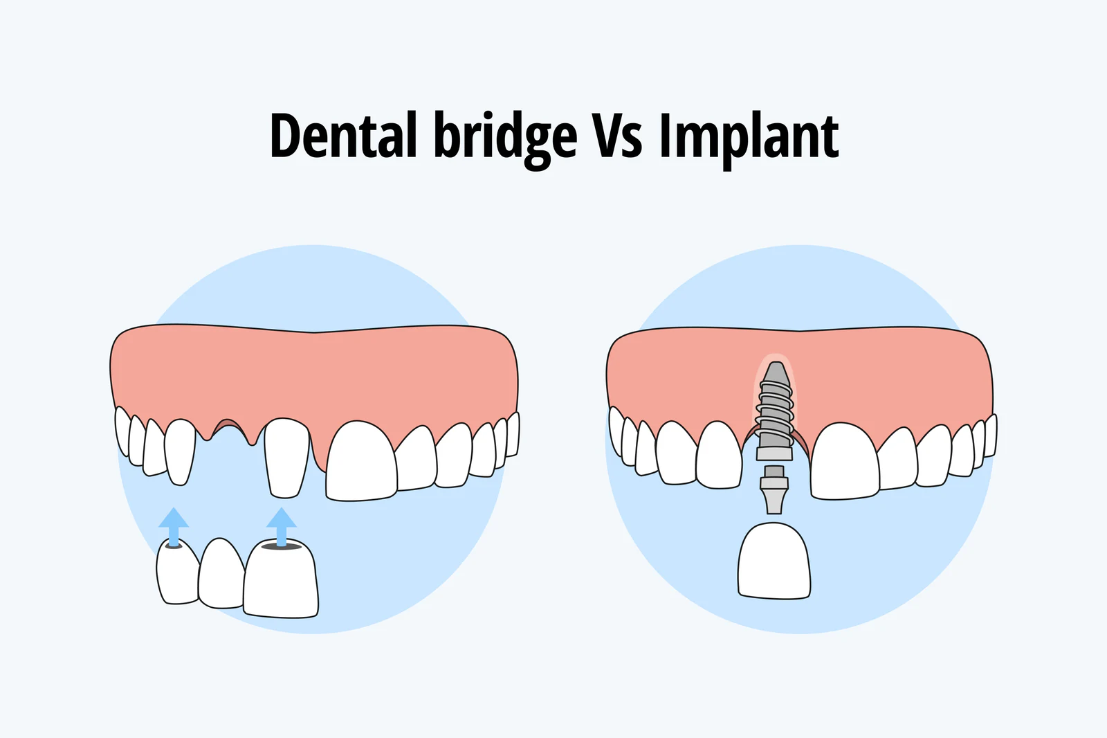 The comparison between dental bridges and dental implants.
