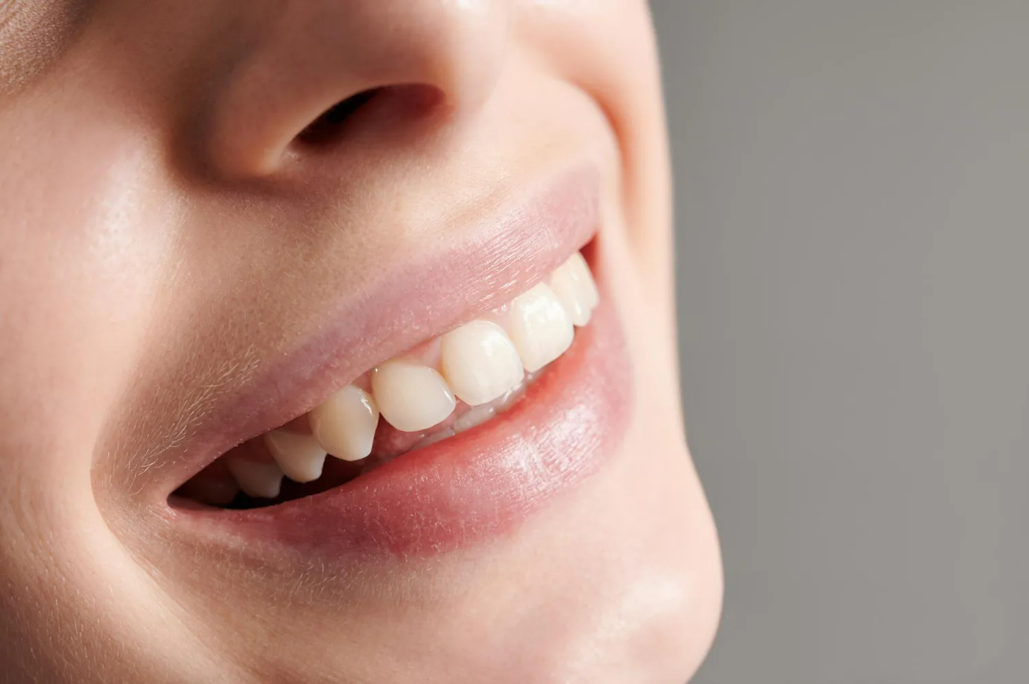 Composite veneers use a tooth-coloured resin material.
