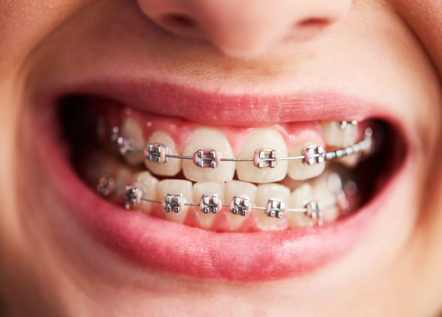 Dental braces help move teeth into a straighter position.
