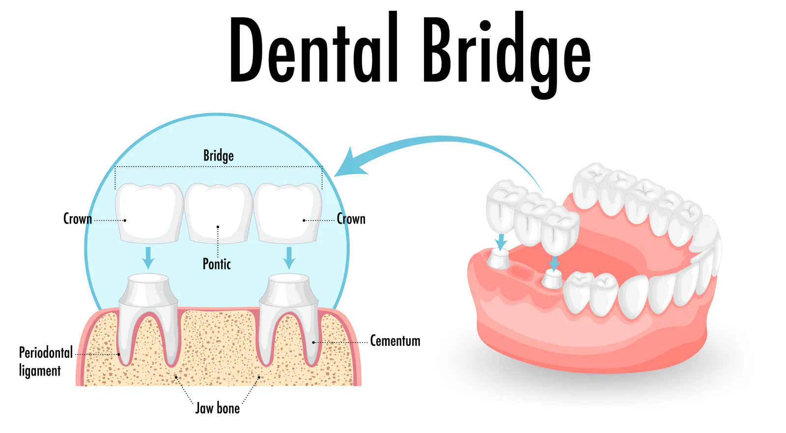 A dental bridge is used to replace missing teeth.