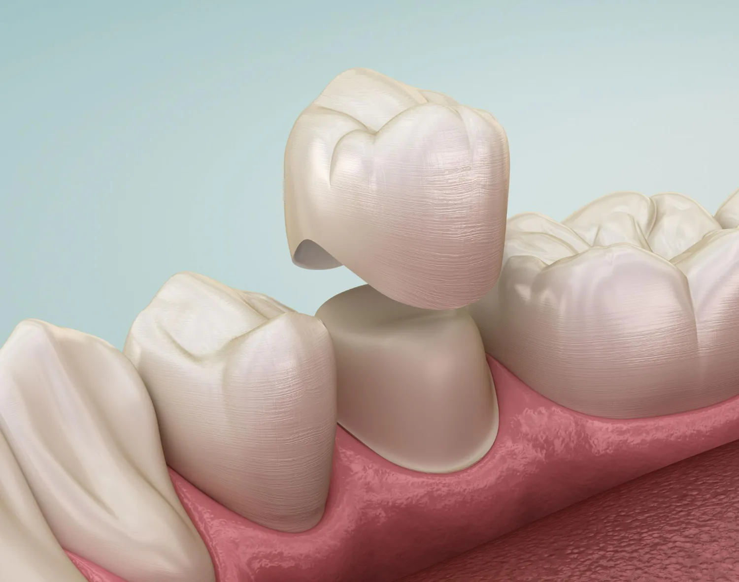 A dental crown.