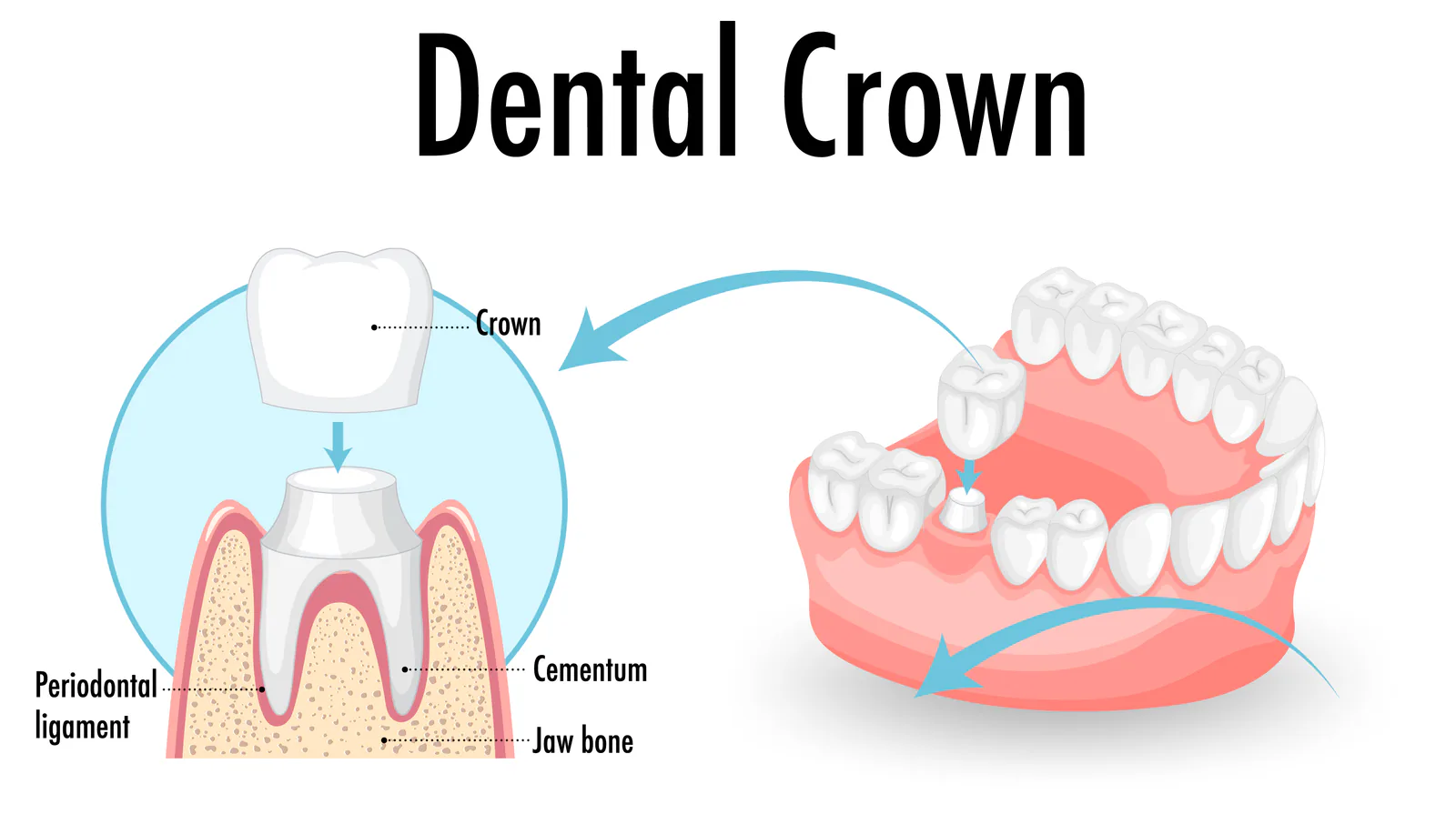 Dental crowns are custom-made covers placed over a tooth to help protect the tooth.