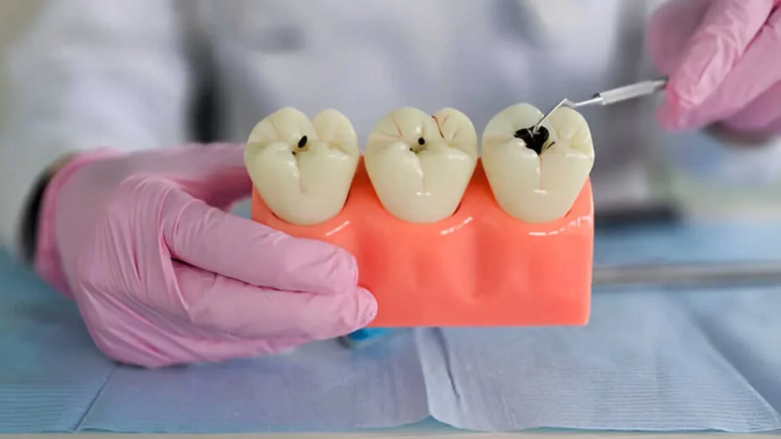 Dental Fillings