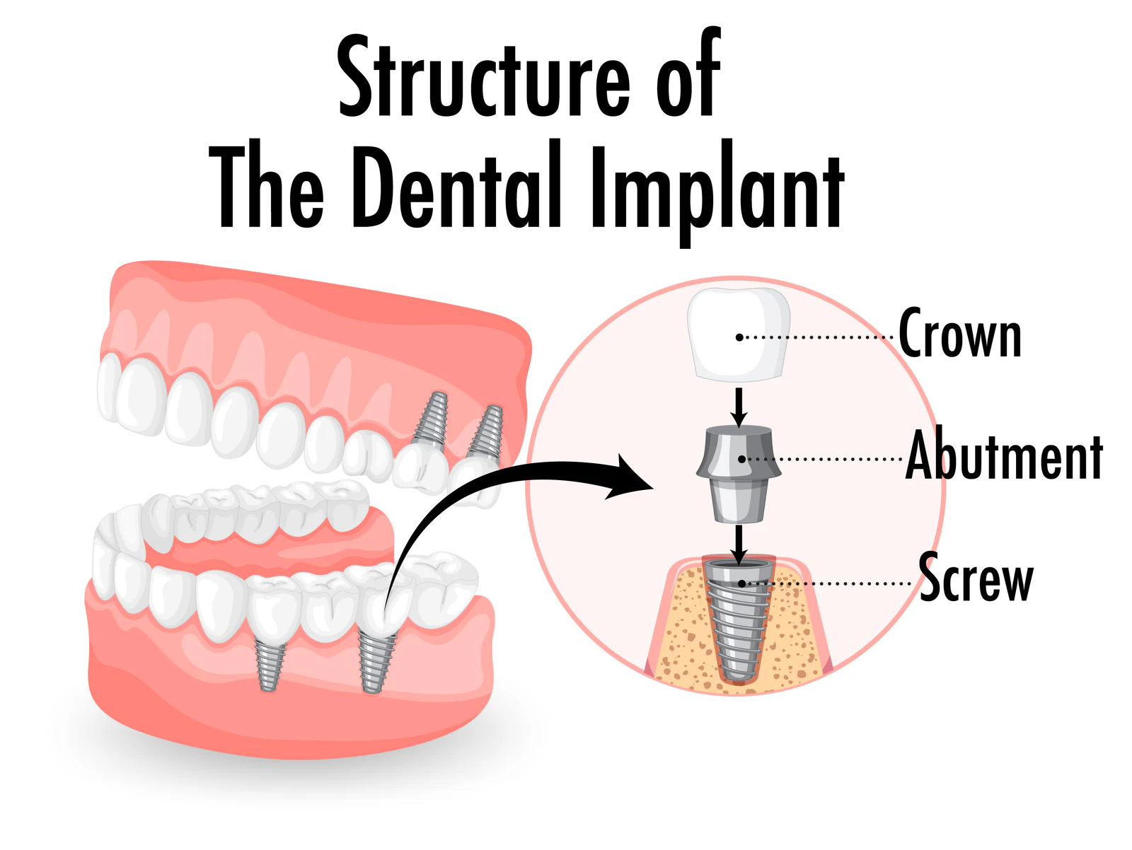 Dental implants support a replacement crown above the gum line.