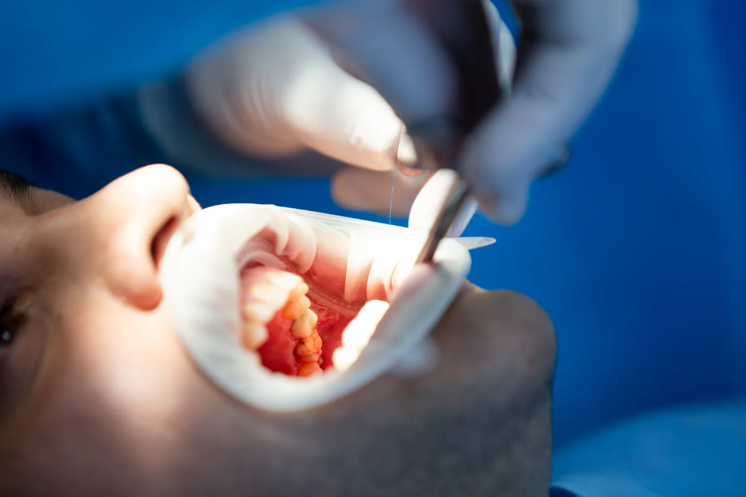 Dentist removing the damaged tooth to make space for the crown.