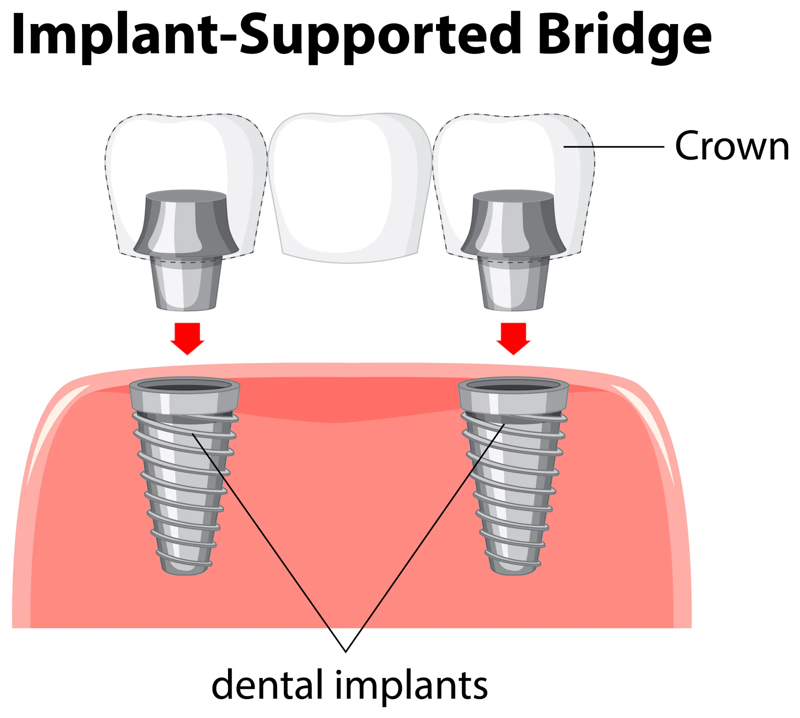 Implant-supported bridge is suitable if you have several teeth in a row missing.