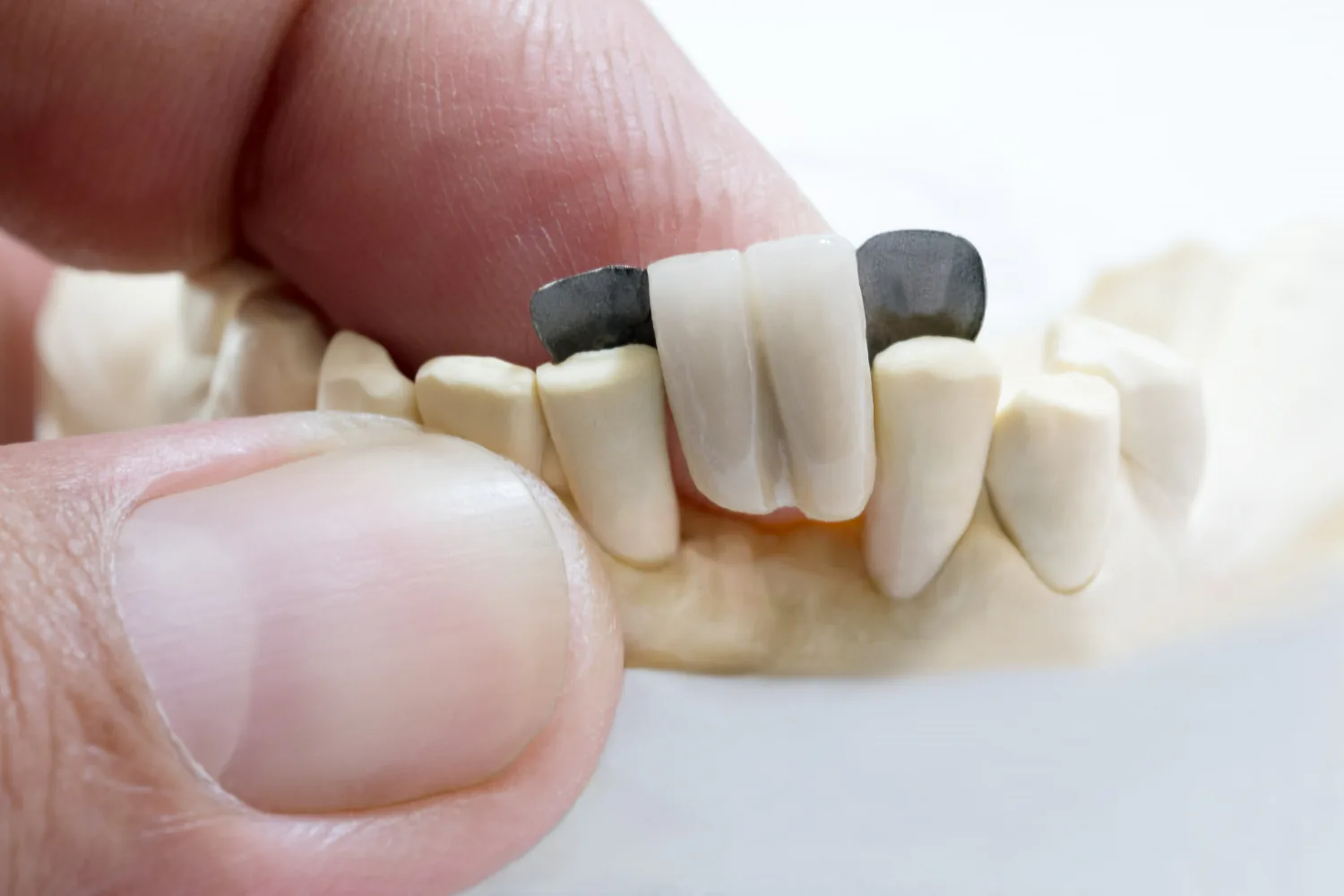 Maryland bridge uses a metal bonded to the back of the neighbouring teeth.