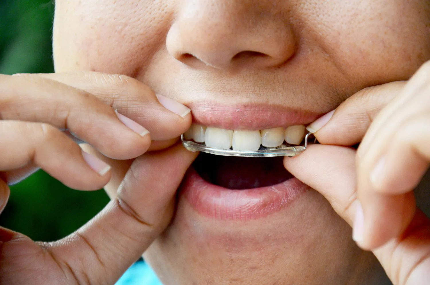 Patient wearing a retainer after they have completed their treatment.