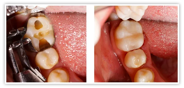 Worn or damaged fillings can expose sensitive areas of the tooth.
