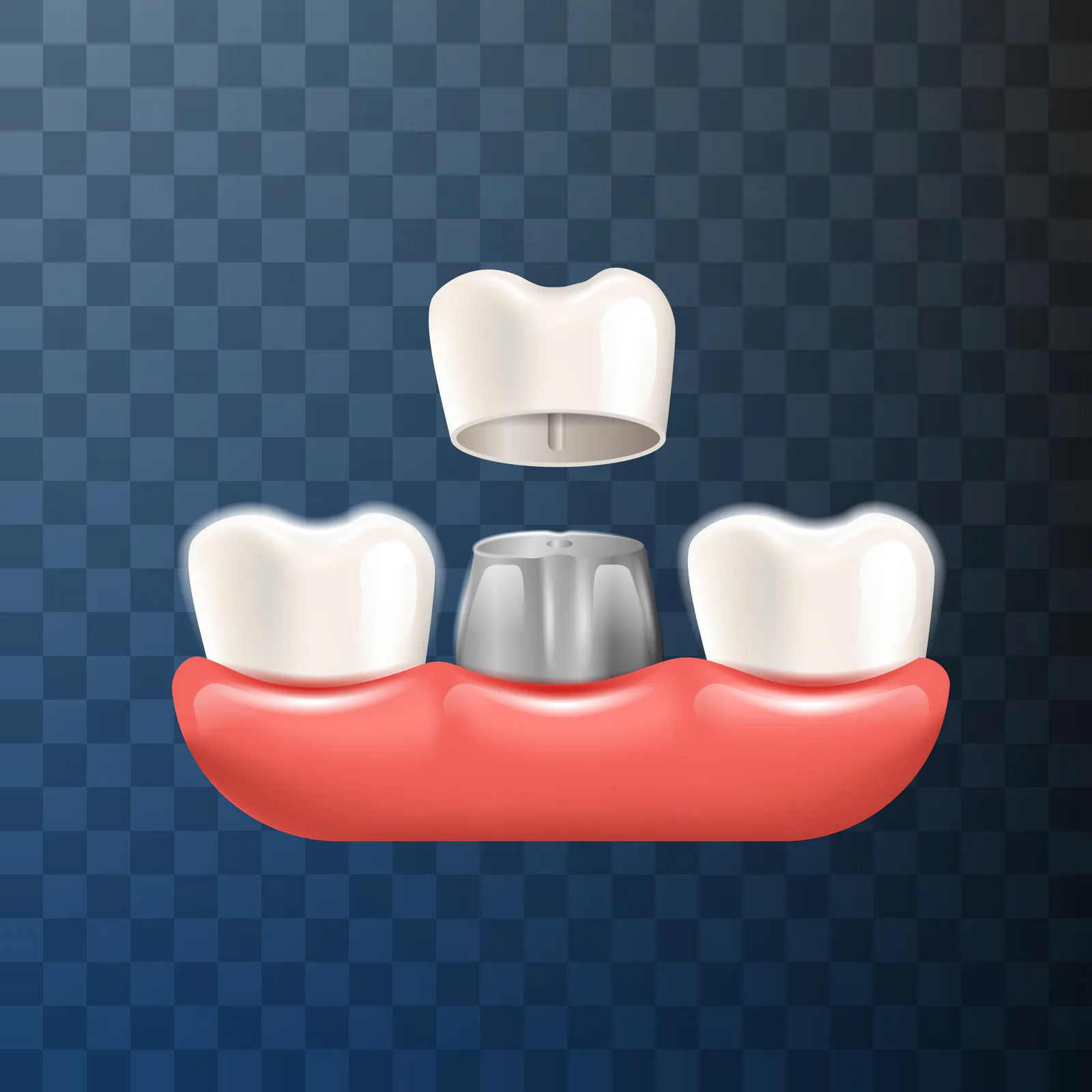 Porcelain-fused-to-metal crowns use a metal base for strength.