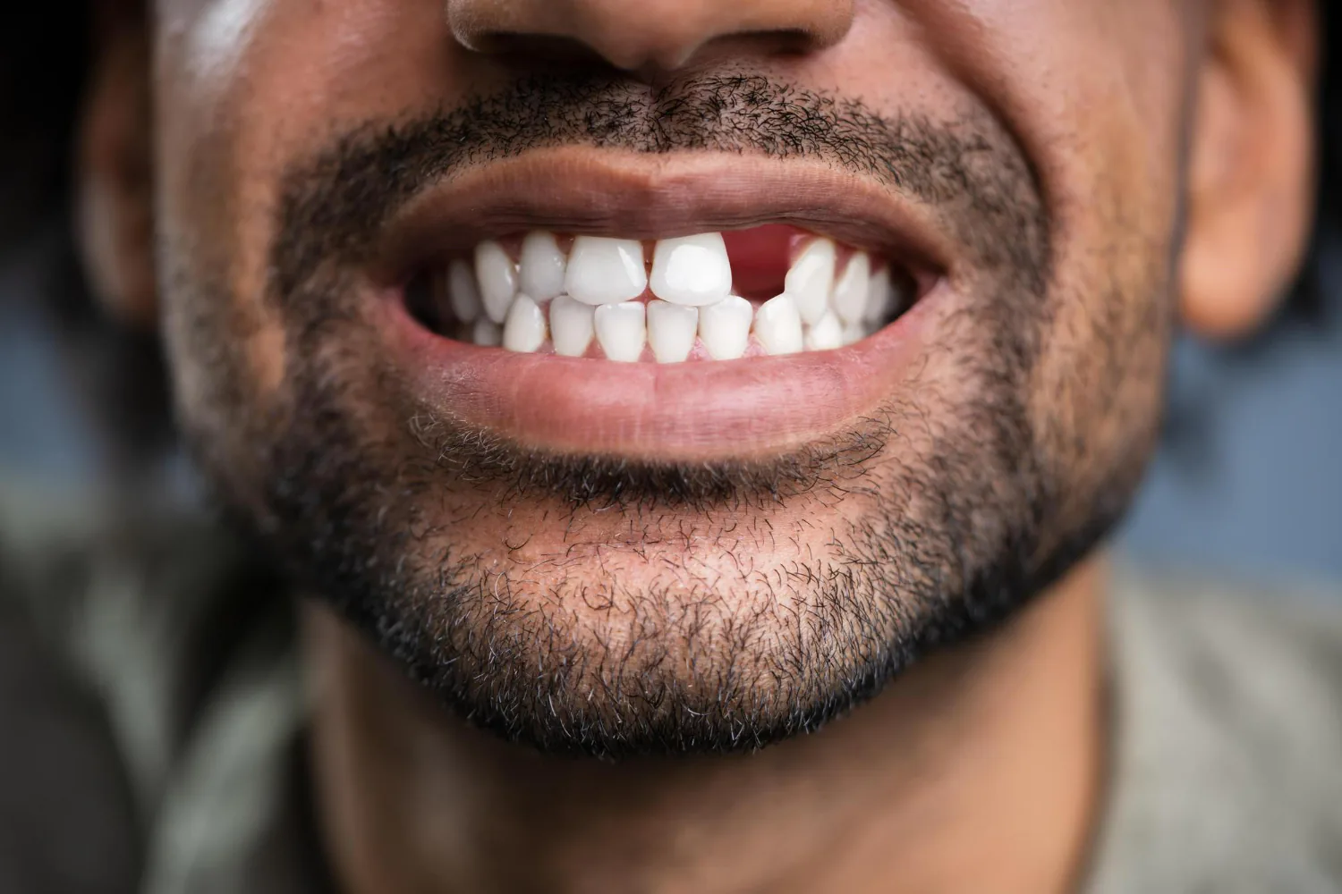 Replacing a missing tooth can be done with dental implants or a dental bridge.