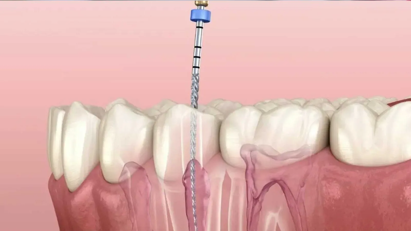 Root Canal Treatment