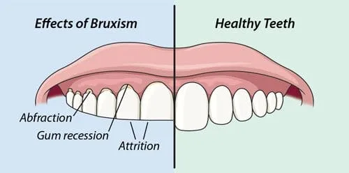 Bruxism can gradually wear down enamel, increasing the risk of tooth sensitivity.