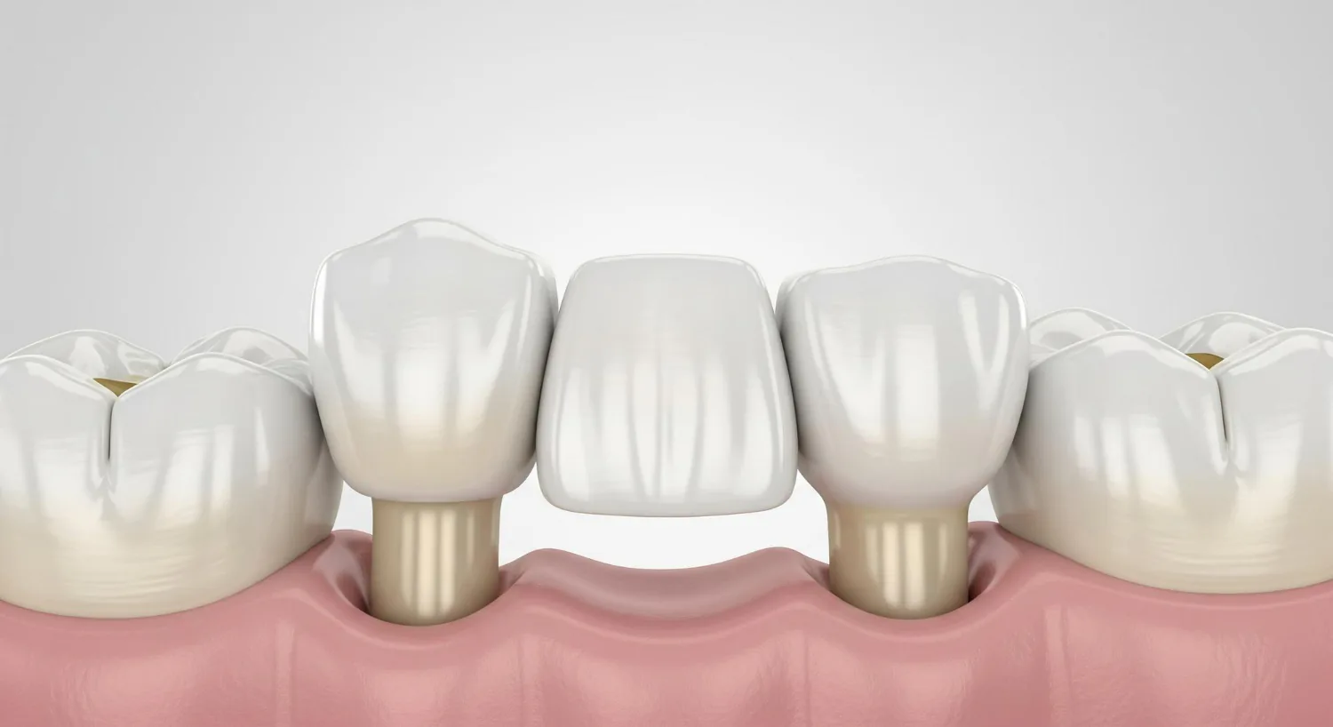 Traditional dental bridge is held in place by a crown.