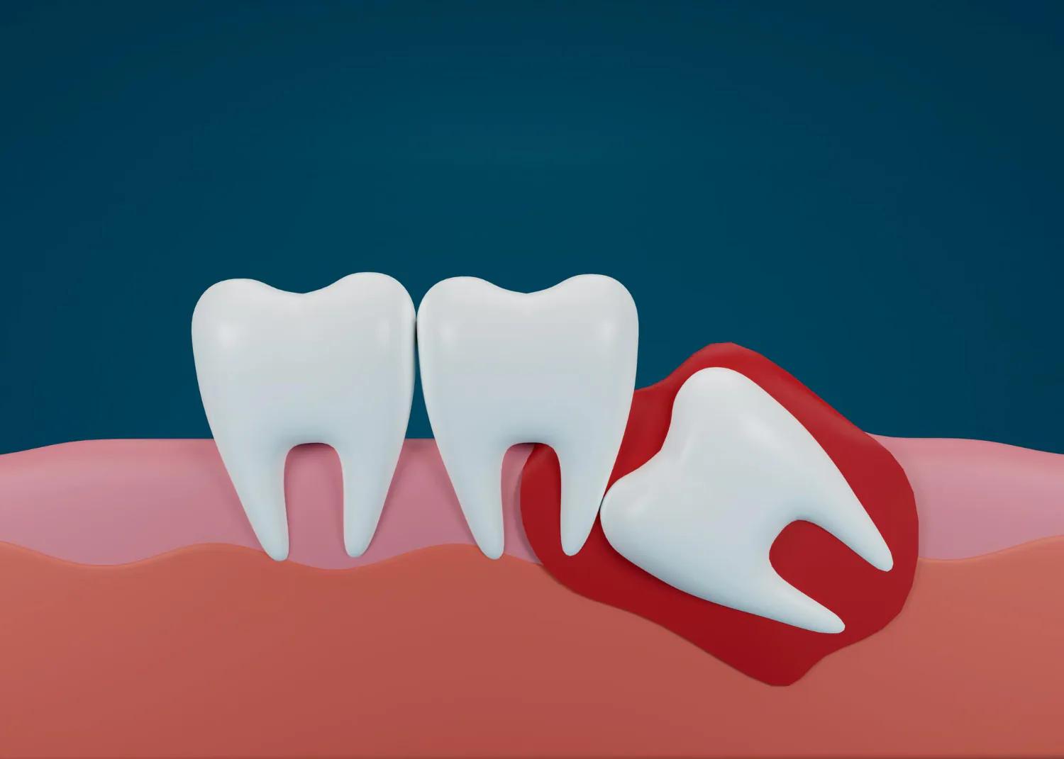 A wisdom tooth is impacted when there is not enough space.