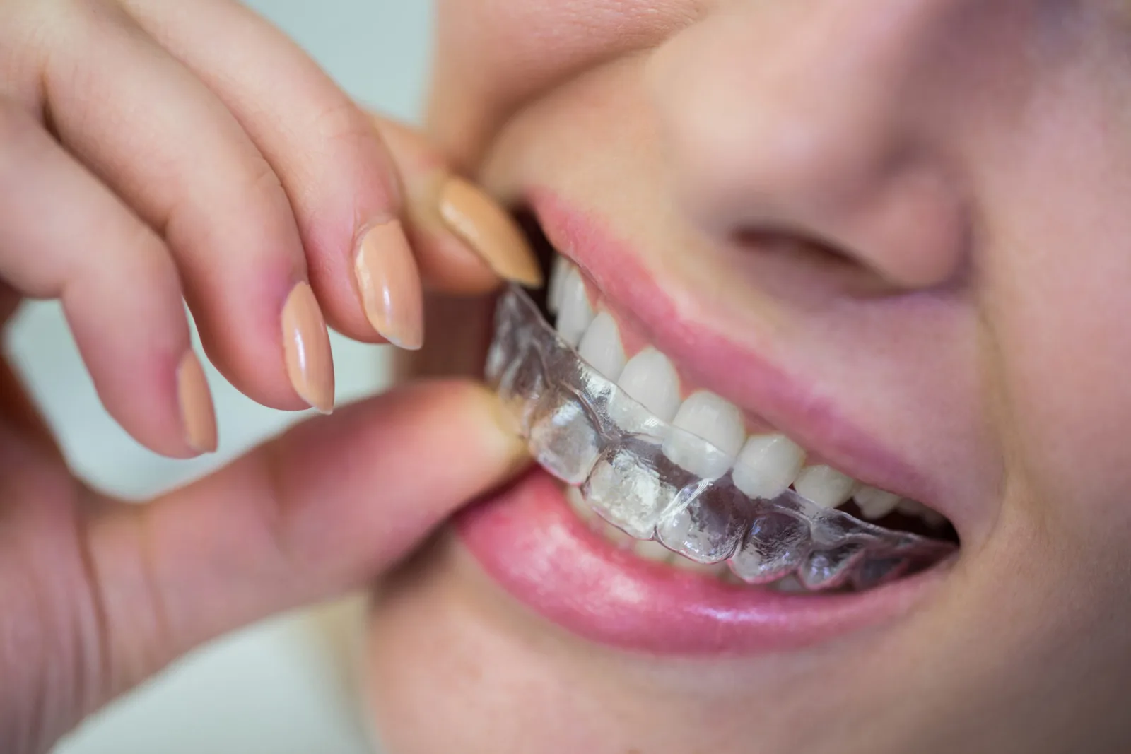 A woman wearing clear, removable Invisalign aligners.