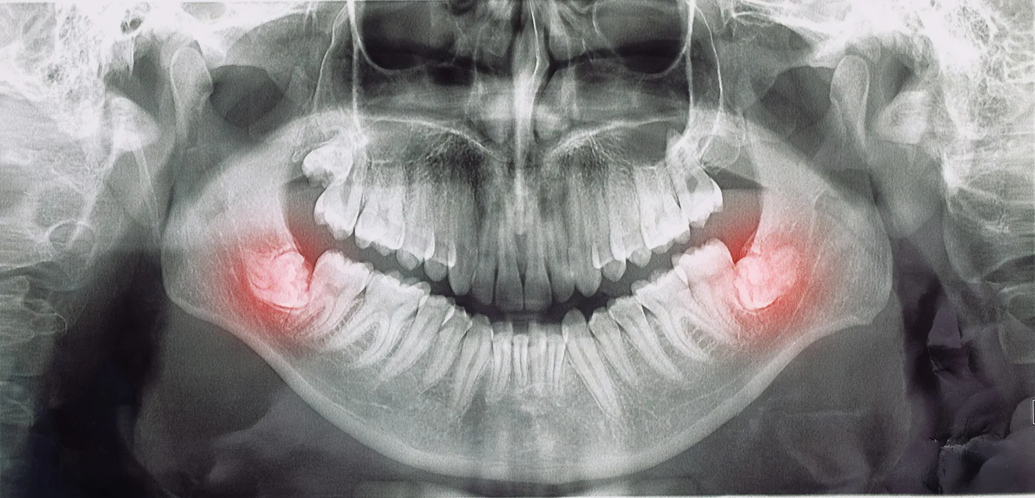 An X-ray of the wisdom teeth.